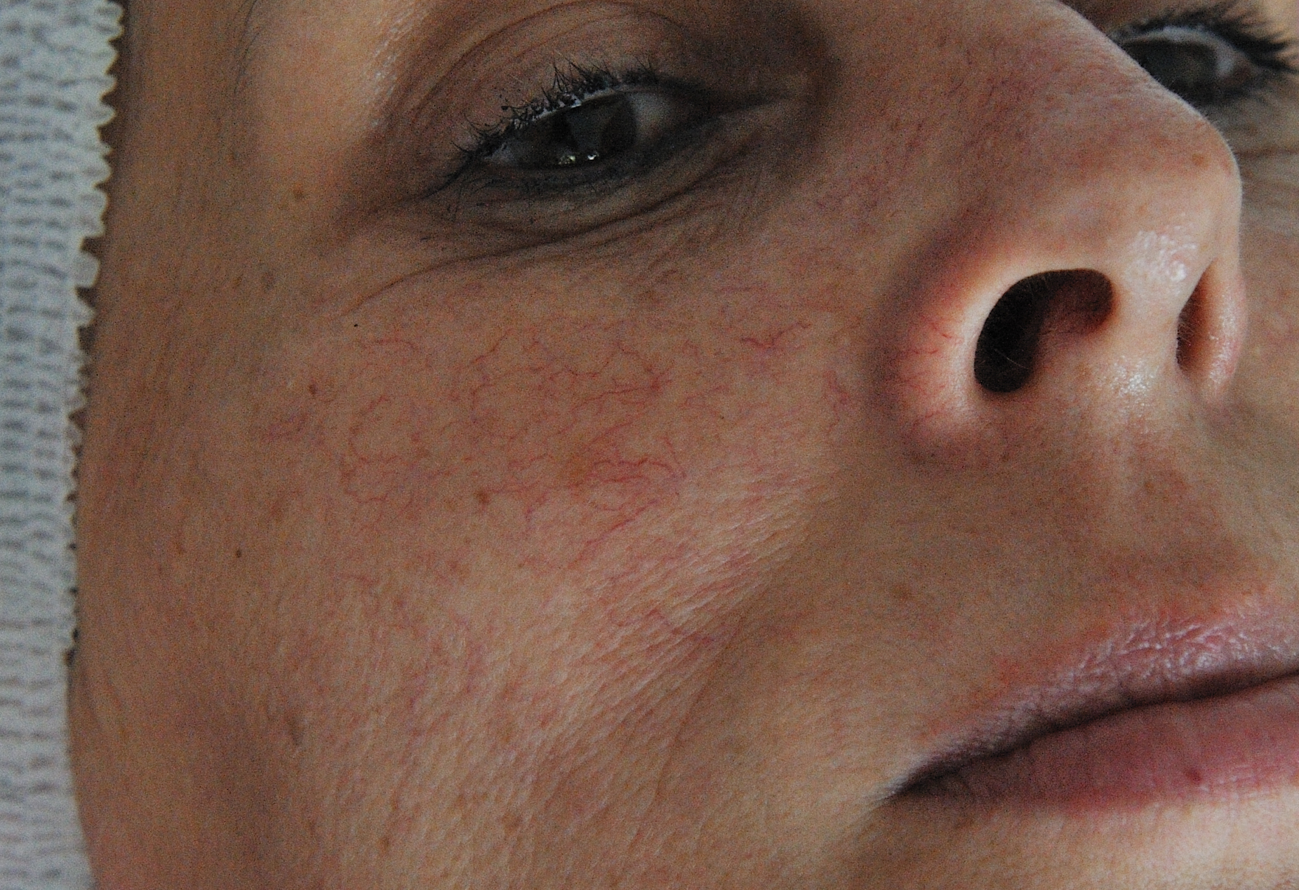 Koagulation BEAUTYfull Kosmetik Atelier in Markkleeberg